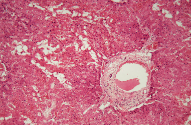 Human liver tissue with Amyloidosis under a microscope.