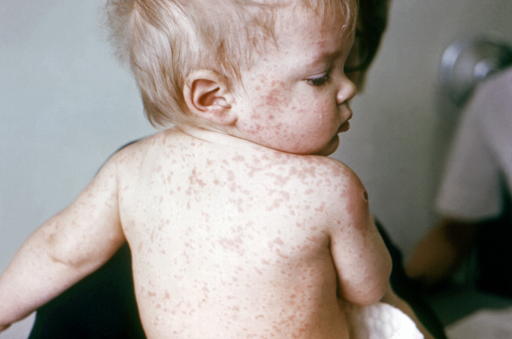 Measles Weakens the Immune System for Years Discover Magazine