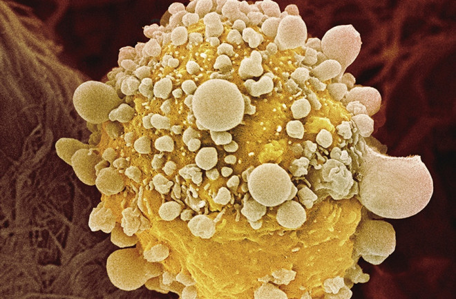 Pancreatic Cancer Cells - Science Source
