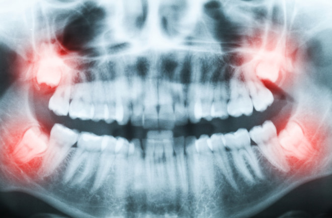 Closeup of x-ray image of teeth and mouth with all four molars vertically impacted