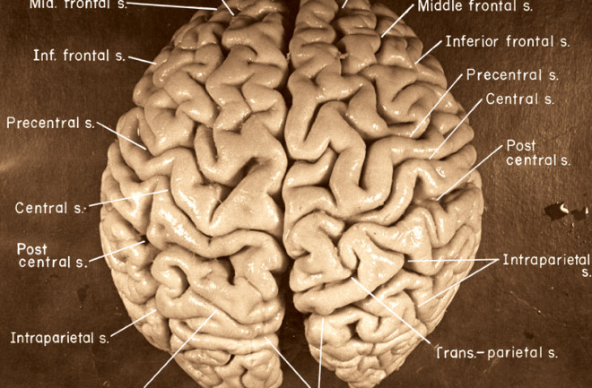 Einstein's Brain - National Museum of Health and Medicine