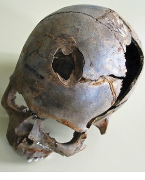 3500 year old skull