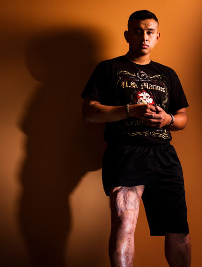 steam cell healing thigh muscle
