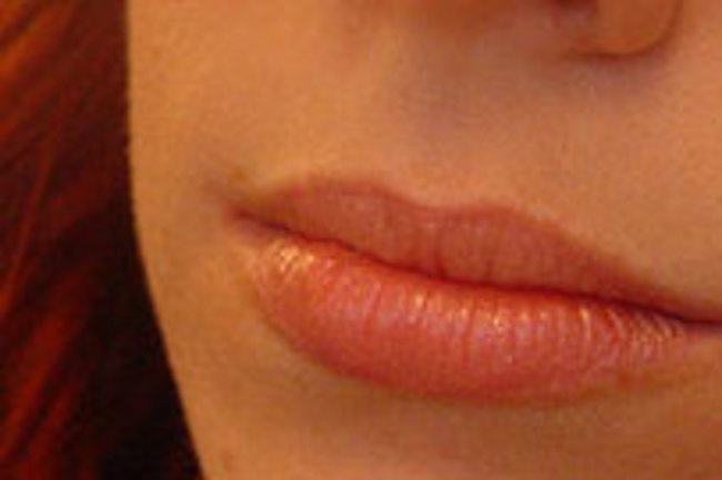 Research Points To A Permanent Cure For Cold Sores Discover Magazine
