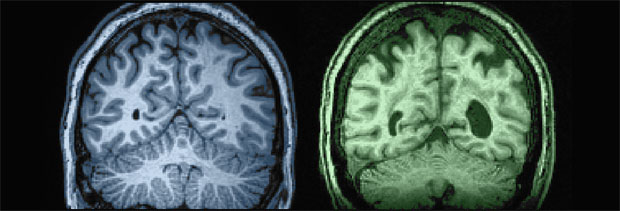 27 year old vs. 87 year old white matter brain comparison