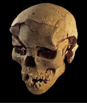 fracture skull