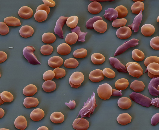 sickle-cell-anemia.jpg