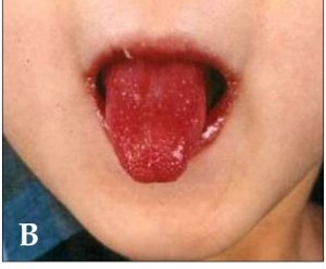 Kawasaki_symptoms_B-e1333638952463.jpg