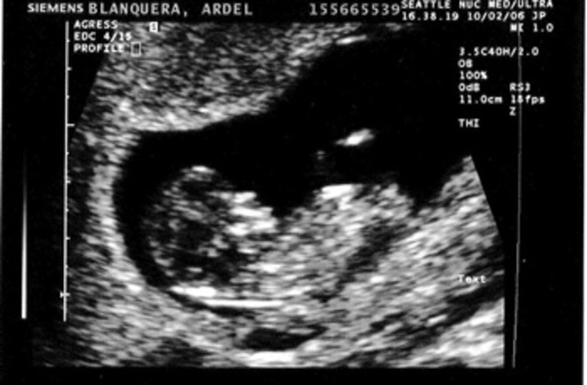 Scientists Confirm Blood Test Can Tell A Fetus S Sex At Seven Weeks Discover Magazine Scientists Confirm Blood Test Can Tell A Fetus S Sex At Seven Weeks Discover Magazine