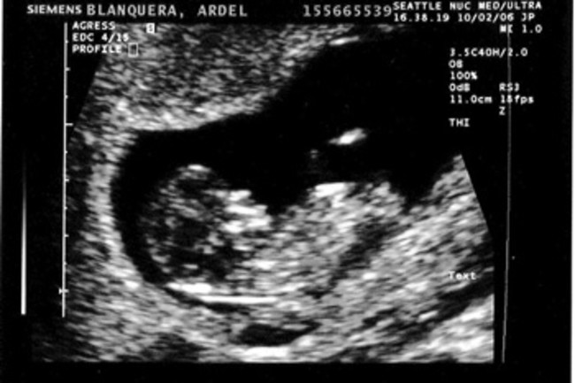 When Can You Find Out The Gender Of A Baby Sneakpeek