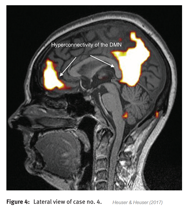heuser_fmri.png
