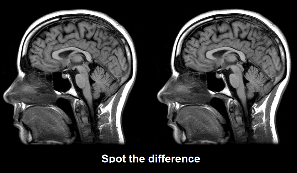 autistic brain vs normal brain