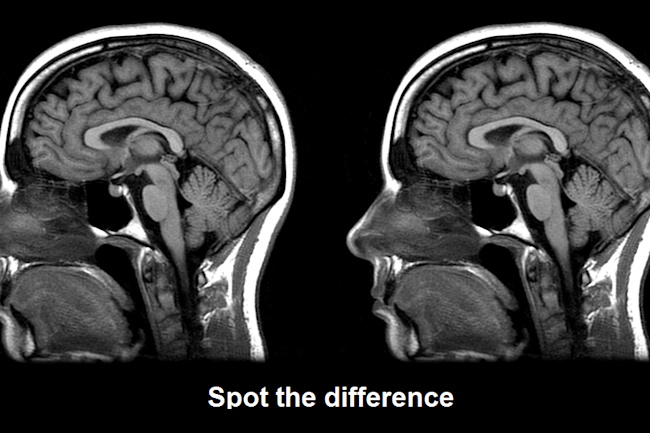 Most Autistic People Have Normal Brain Anatomy Discover Magazine