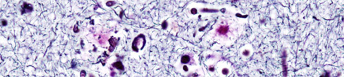 Amyloidbetaplaques.jpg