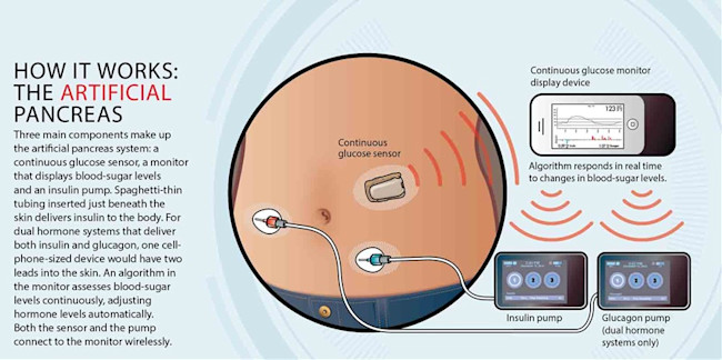 artificial pancreas