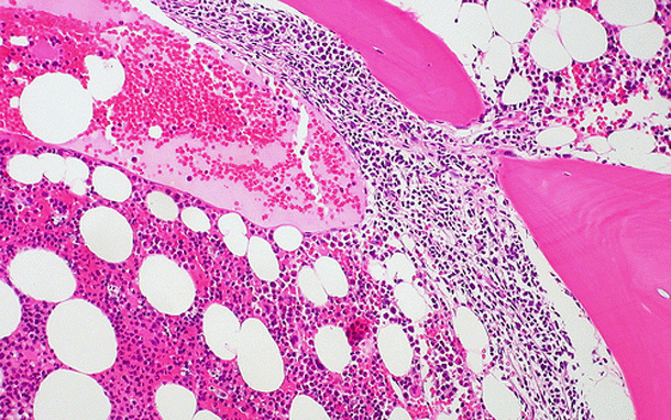 Lymphoma-cells.gif