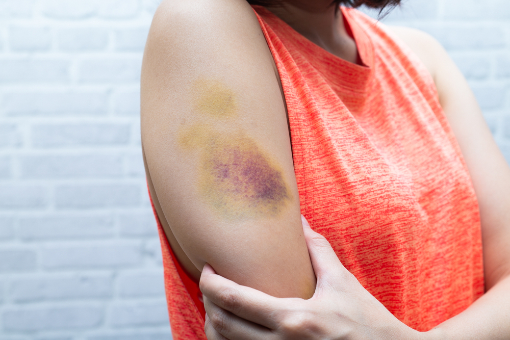 Do Leukemia Bruises Turn Yellow