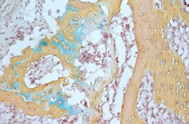 A small microscope image of a bone structure that developed from human skeletal stem cells. Blue coloring indicates cartilage, brown represents bone marrow and yellow shows bone.