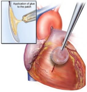 heart-glue-284x300.jpg
