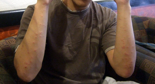 Edbedbugs.jpg