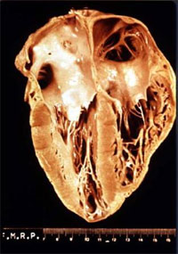 Chagas_heart.jpg