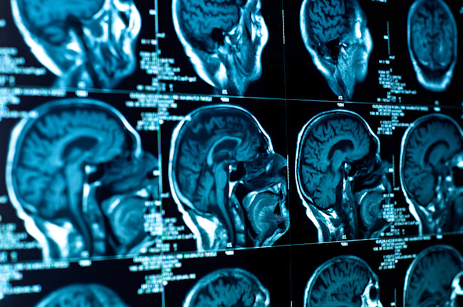 parkinsons-brains.jpg