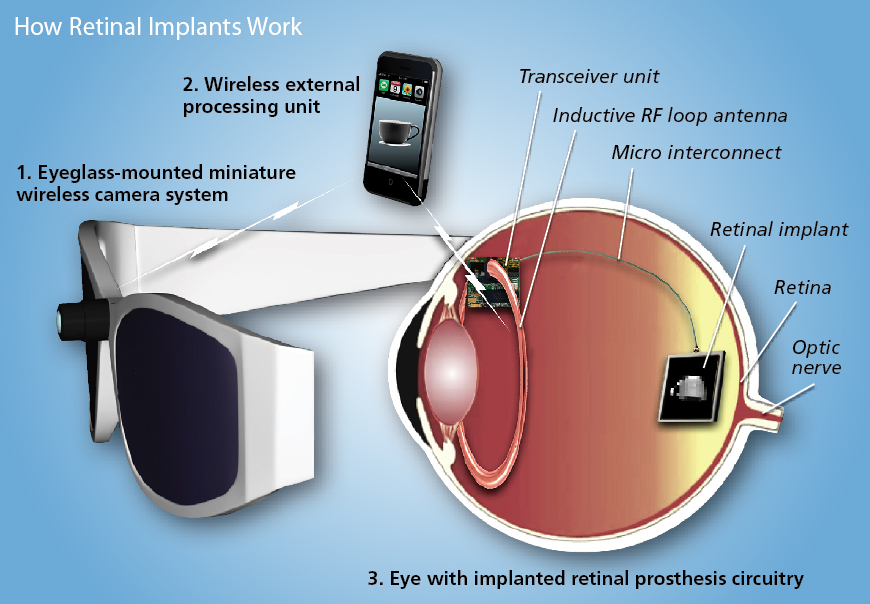 retinal-implants.jpg