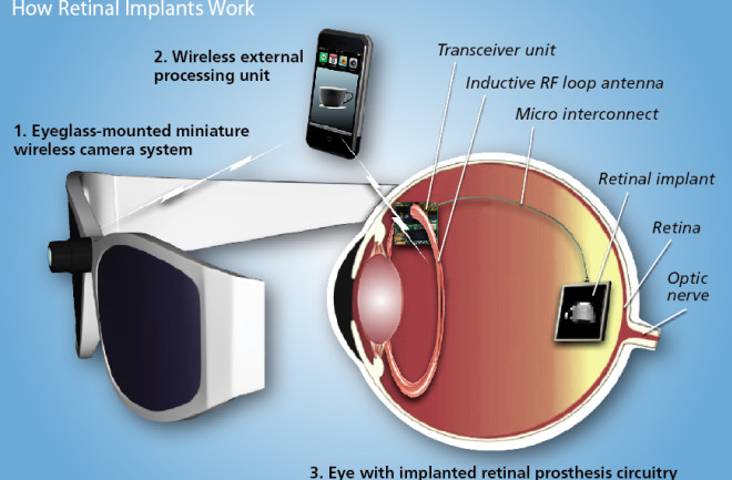 retinal-implants.jpg