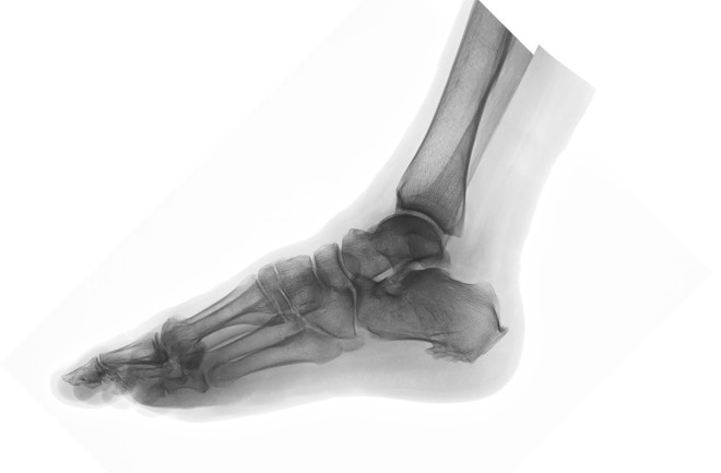 Foot X-ray - Shutterstock