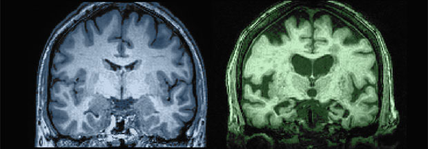 27 year old vs. 87 year old subarachnoid space brain comparison