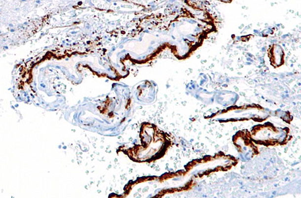 Amyloid_beta.jpg
