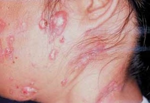 Mycobacteria_300.jpg