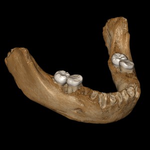 Xiahe-Mandible-Reconstruction-300x300.jpg
