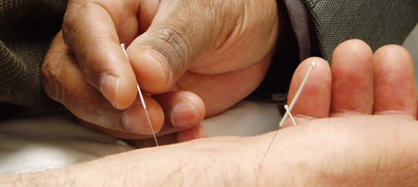 Acupuncture.jpg