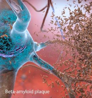 beta-amyloid-plaque
