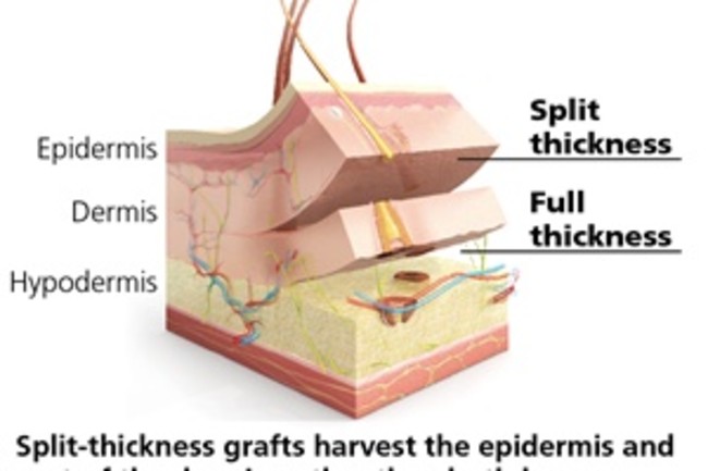 split-thickness
