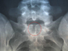Spina_Bifida.jpg