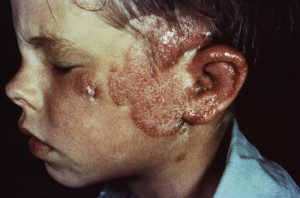 A ringworm infection caused by a species of Tinea fungus on both the face and scalp. Image: CDC.