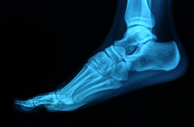 Foot x-ray