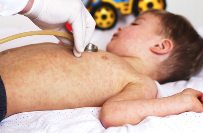 child with a rash doctor measures MIS-C Covid-19 - shutterstock