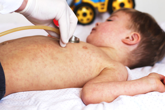 Kids Aren T Spared From The Coronavirus A New Inflammatory Condition In Children Is On The Rise Discover Magazine