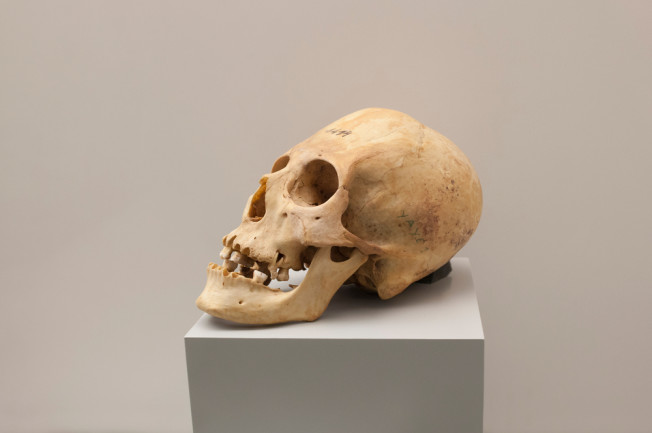 elongated skull