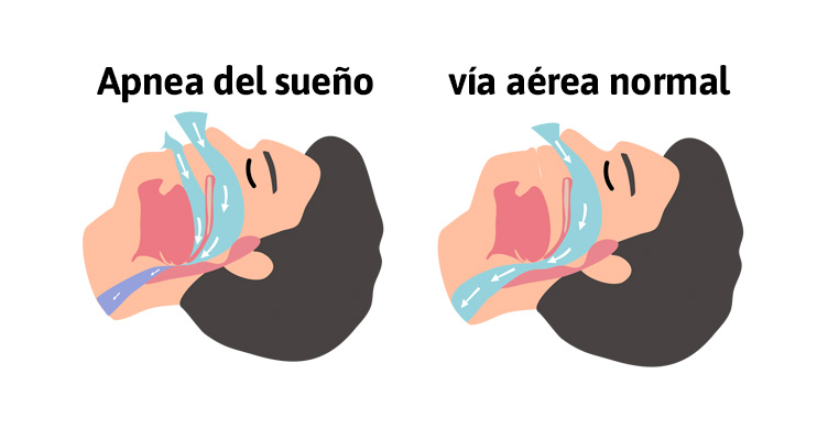 Apnea obstructiva del sueño y problemas para dormir - TENA