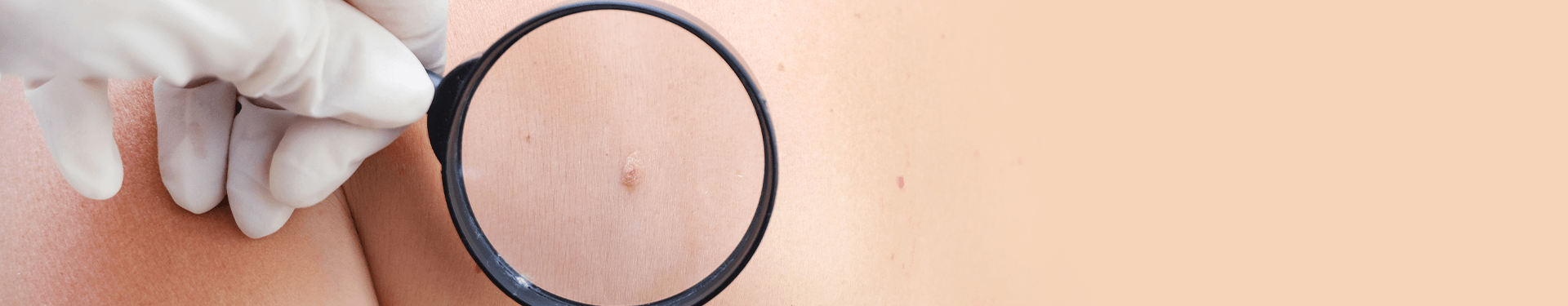 ulceras por presión