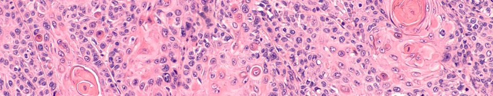 Síntomas del Papiloma Humano: Prevención del VPH - TENA