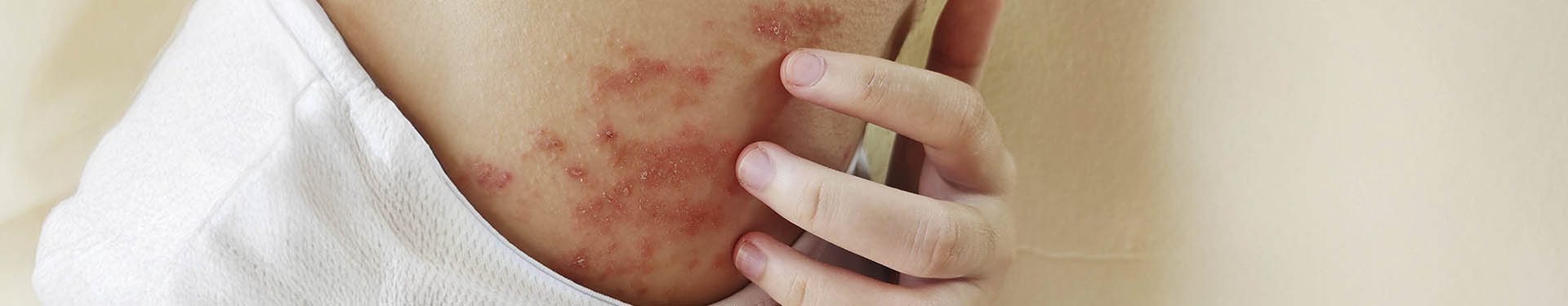 Tratamiento para la dermatitis de pañal en adultos: causas, síntomas y prevención