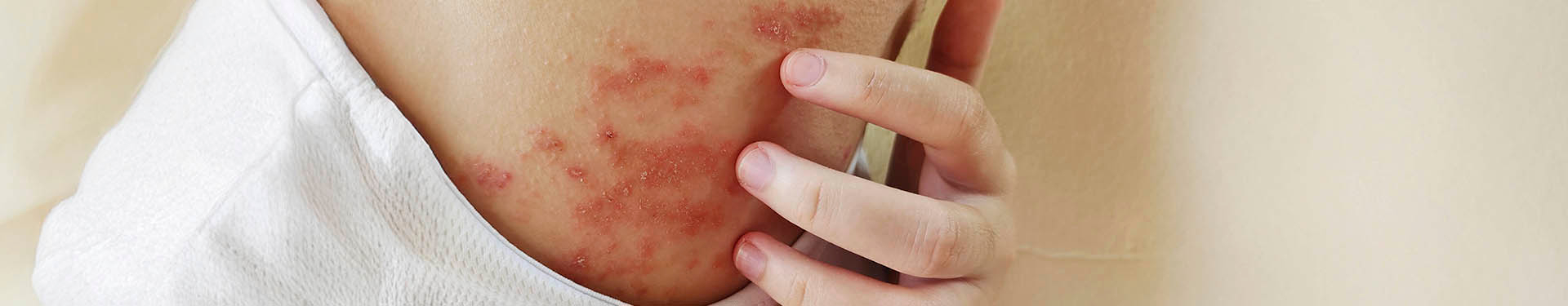 Tratamiento para la dermatitis de pañal en adultos: causas, síntomas y prevención