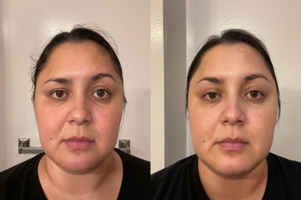 Before and after comparison images from using Inflammation Response 