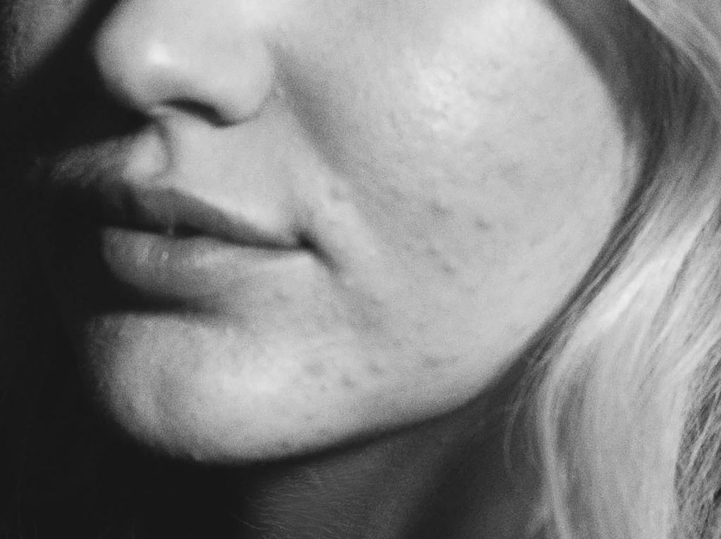 Close view of woman's cheek and jaw with inflamed acne bumps