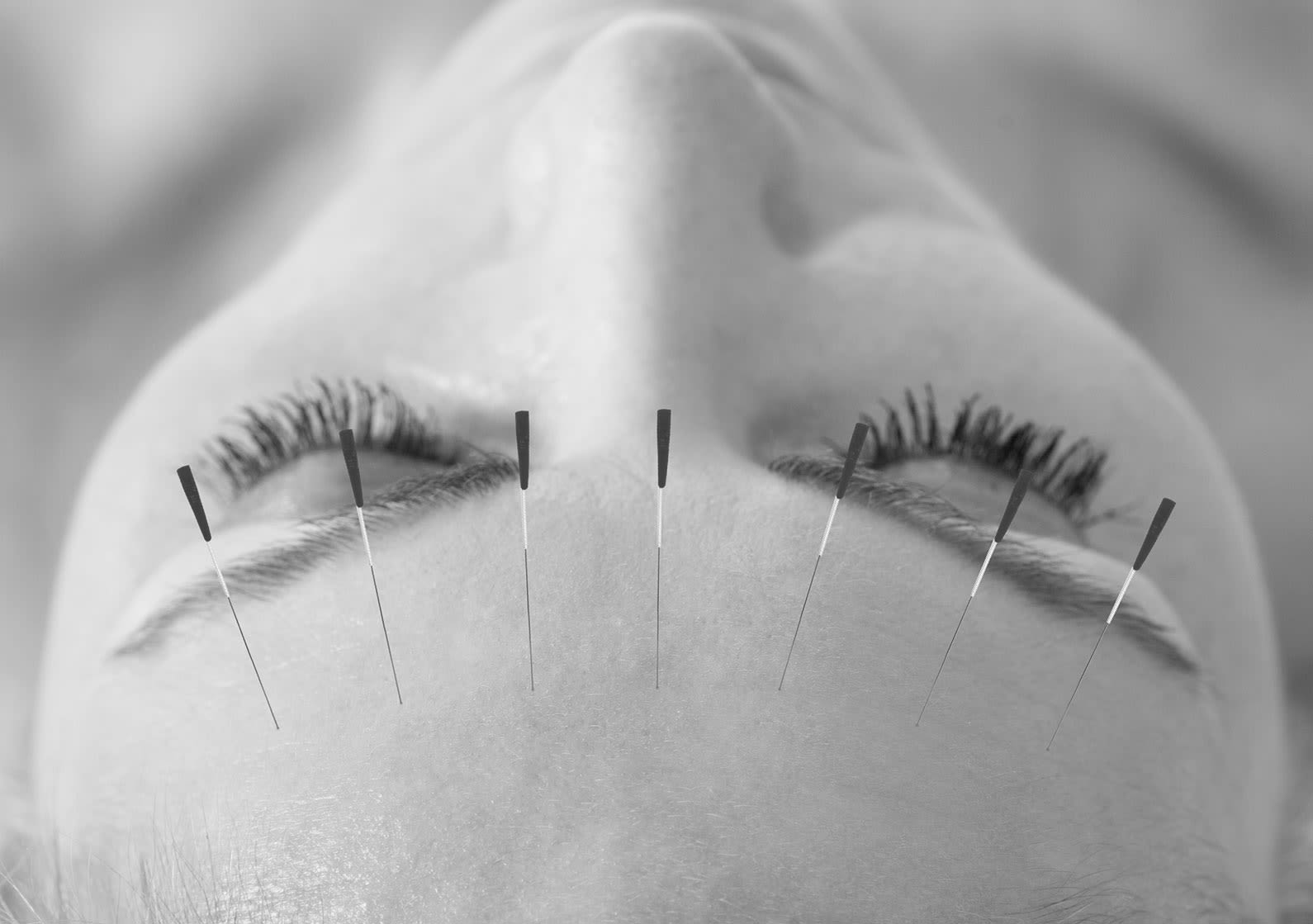 Woman lying down with acupuncture needles in her forehead.